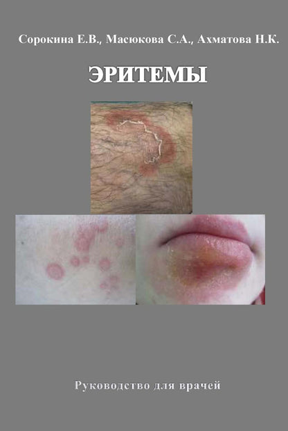 Эритемы. Руководство для врачей