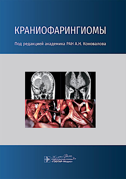 Краниофарингиомы / под ред. А. Н. Коновалова. — Москва : ГЭОТАР-Медиа, 2025. — 160 с. : ил.